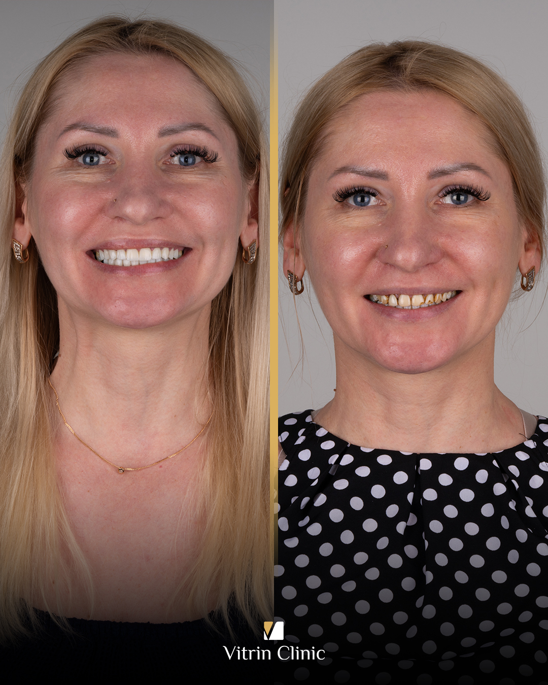 What Is the Fatigue Reliability of Dental Implant Crowns, and How Long Do They Last?